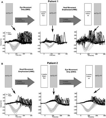 Head-Movement-Emphasized Rehabilitation in Bilateral Vestibulopathy